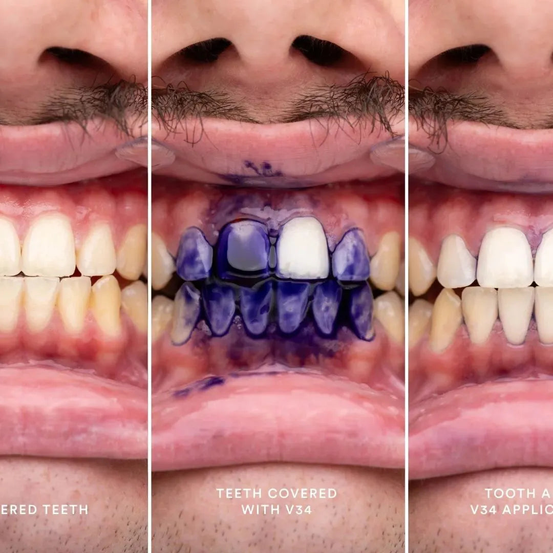 Radiant Smile (Blanqueador Dental)